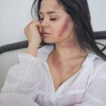 woman with bruises