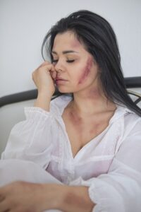woman with bruises
